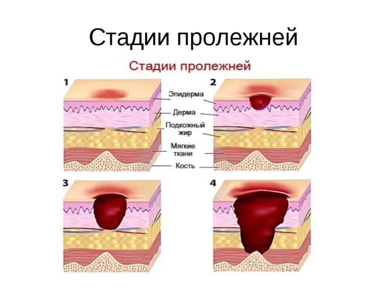 Пролежни 4 стадии фото