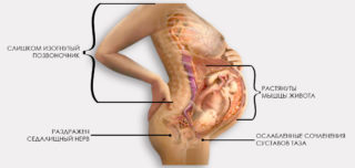 Защемление седалищного нерва при беременности как рожать
