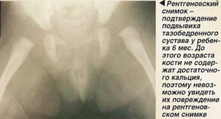 Рентген описание дисплазии тазобедренных суставов у детей