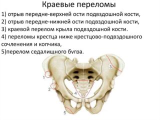 Ушиб подвздошной кости симптомы