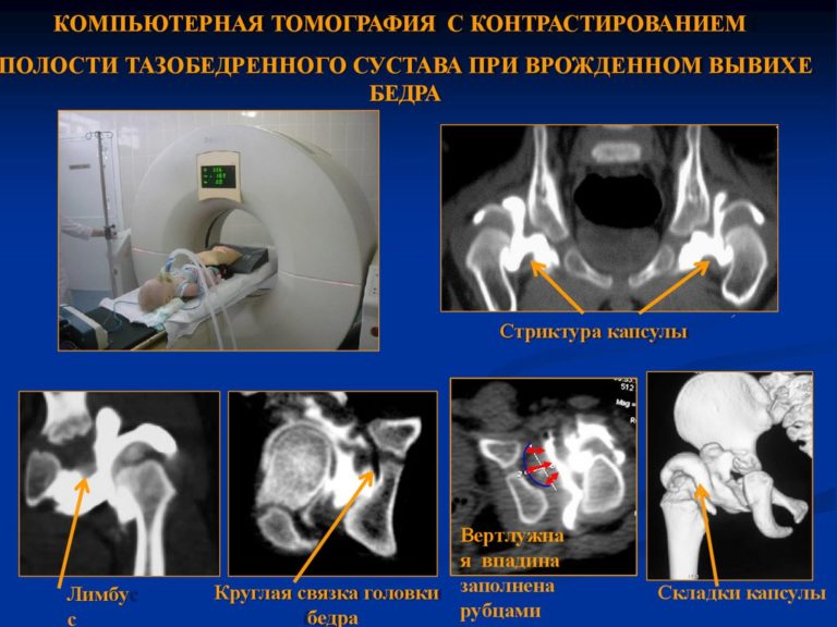 Компьютерная томография тазобедренного сустава что показывает