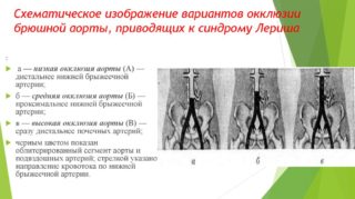Атеросклероз аорты подвздошных артерий