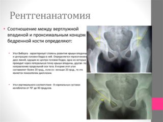 Изображение - Рентгеновский снимок здорового тазобедренного сустава slide-19-1-1-320x240