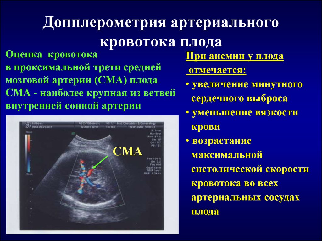 Допплерография ребенку. Допплерометрия сосудов плода. Средняя мозговая артерия допплер норма. УЗИ допплерография маточно-плацентарного кровотока.