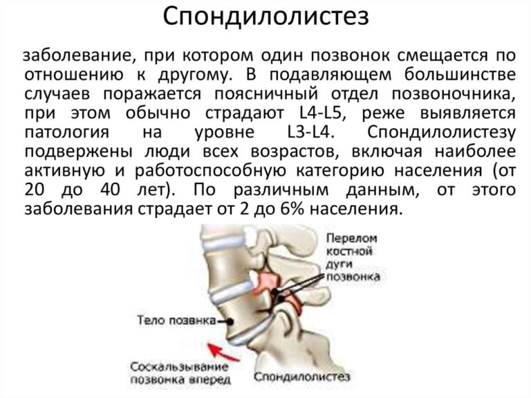 Где проходит седалищный нерв фото