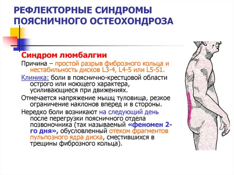 Симптом Ласега: причины возникновения, степени, проведение теста и лечение