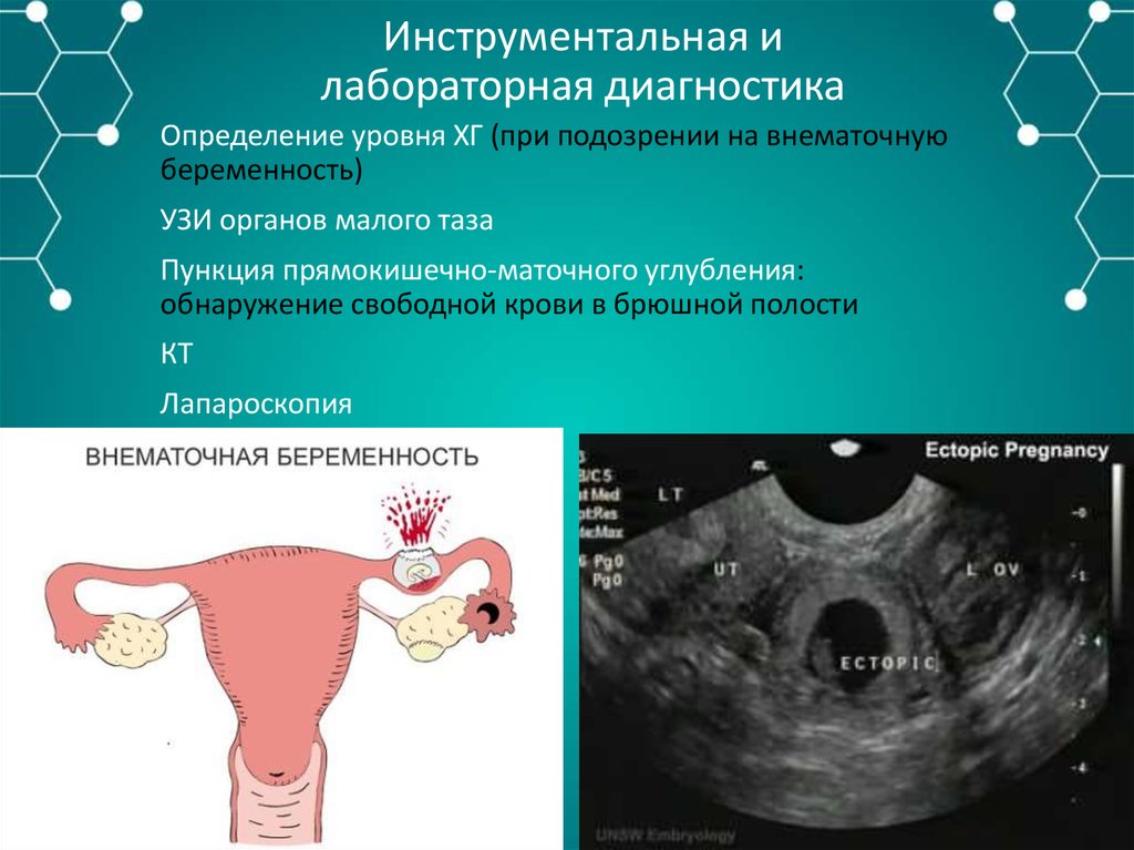 Ли сохранить внематочную беременность