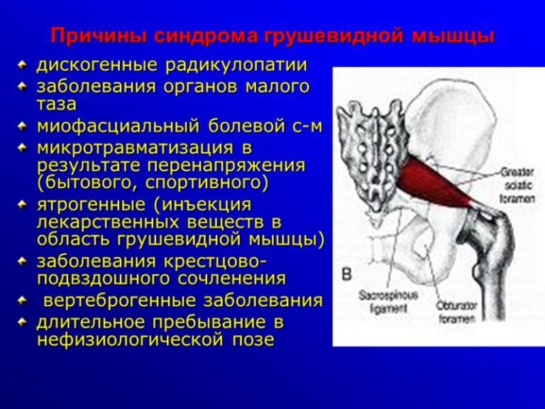 Синдром грушевидной мышцы фото