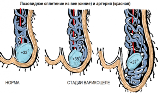 Атеросклерозом сосудов малого таза