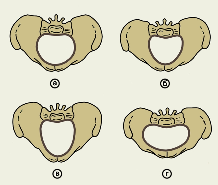 Гинекоидный таз. Формы сужения таза Акушерство. Акушерская патология узкий таз. Классификация узкого таза Акушерство. Анатомический узкий таз в акушерстве.