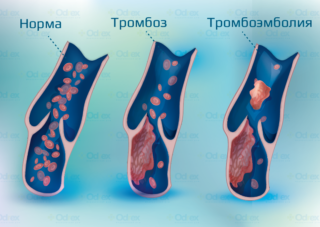 Атеросклероз артерий малого таза