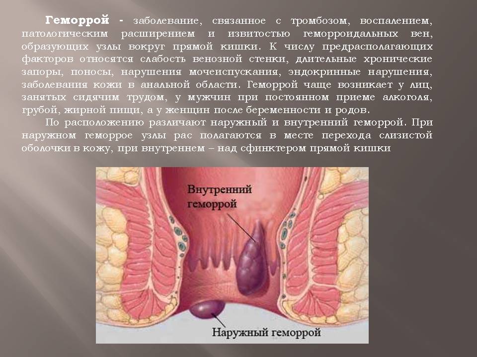 Тромбофлебит заднего прохода