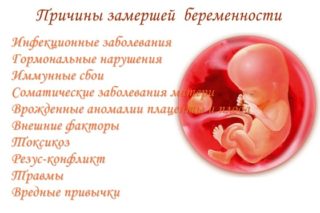 При замершей беременности болит живот или нет thumbnail