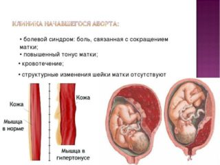 Боли внизу живота у женщин при беременности 19 недель thumbnail