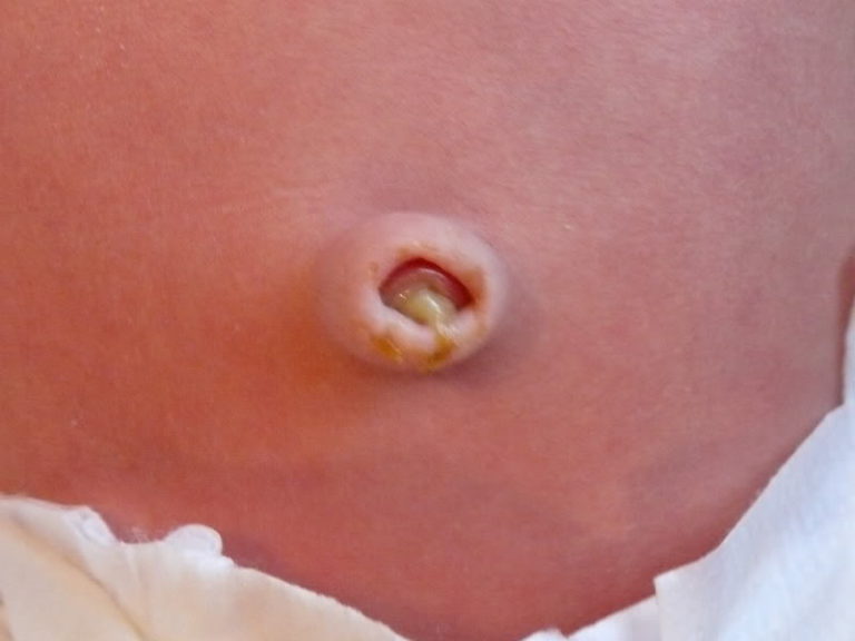 Фунгус пупка гранулема у новорожденных причины лечение и последствия
