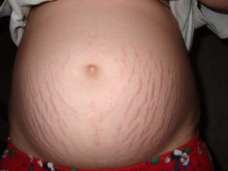 Красные пятнышки при беременности на животе thumbnail