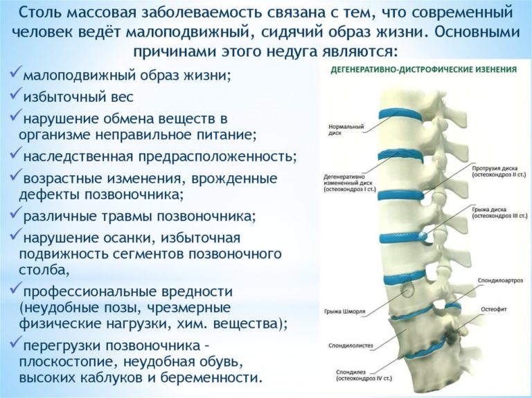 Остеохондроз причины заболевания компьютер