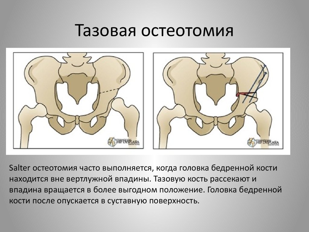 Изменения костей таза. Остеотомия таза по Солтеру. Остеотомия таза по Salter. Расхождение костей таза.