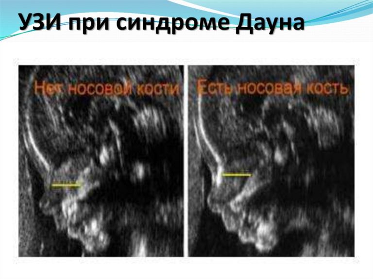 Какой живот на 3 месяце беременности фото