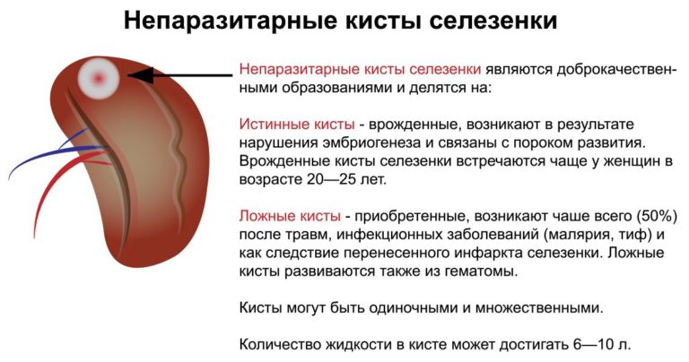 Киста большого сальника