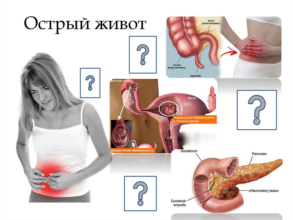 Острый живот. Острый Животв в гинекология.