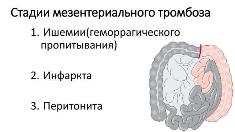 Карта вызова смп тромбоз верхней конечности