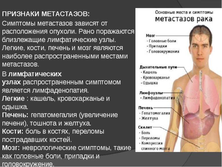 Подкожные метастазы при рмж фото