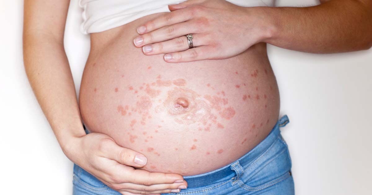 Сыпь на животе при беременности – аллергия, раздражение, инфекция?