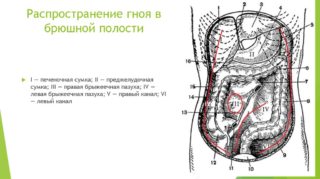 Забрюшинная флегмона код мкб