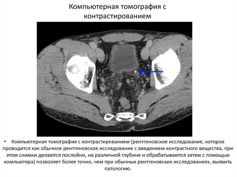 Асцит брюшной полости фото