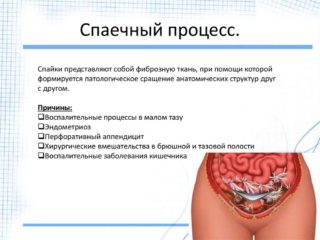 Последствия перитонита язва желудка