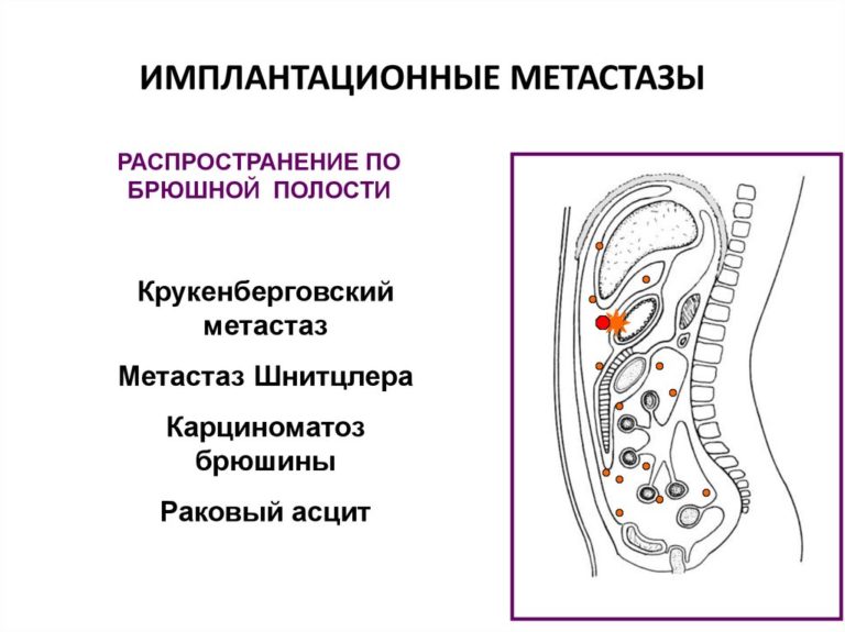 Метастазы в сальнике прогноз