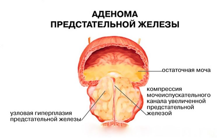 Зеленый стул и рези в животе