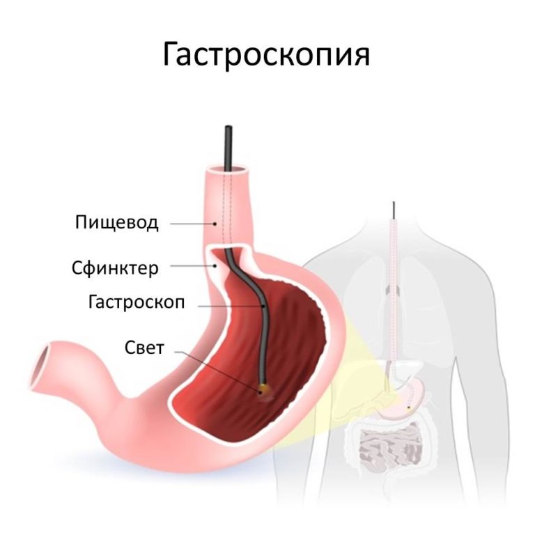 Нерегулярный стул и вздутие живота