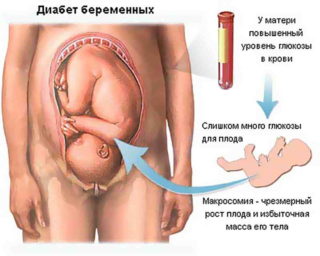 На каком месяце беременности начинает расти живот при второй беременности thumbnail