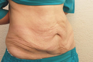 Как убрать обвисший после похудения живот у мужчин и женщин: способы и профилактические меры