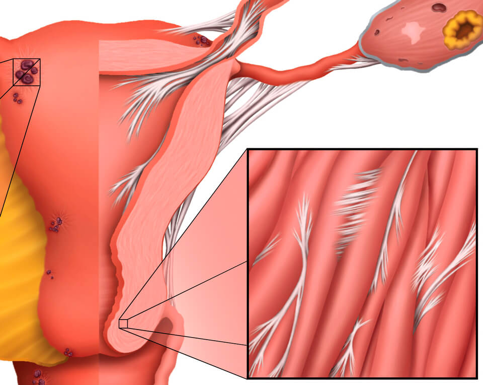 Синехии в полости матки что это. Эндометриоз спаечный процесс органов малого таза. Спаечный процесс в маточных трубах.