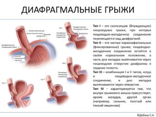 Болит желудок в области диафрагмы thumbnail
