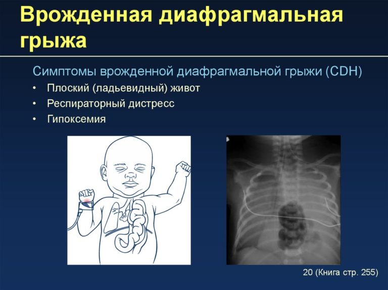 Диафрагмальная грыжа у детей фото