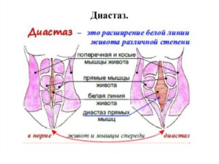 Диастаза прямых мышц живота мкб 10 код thumbnail