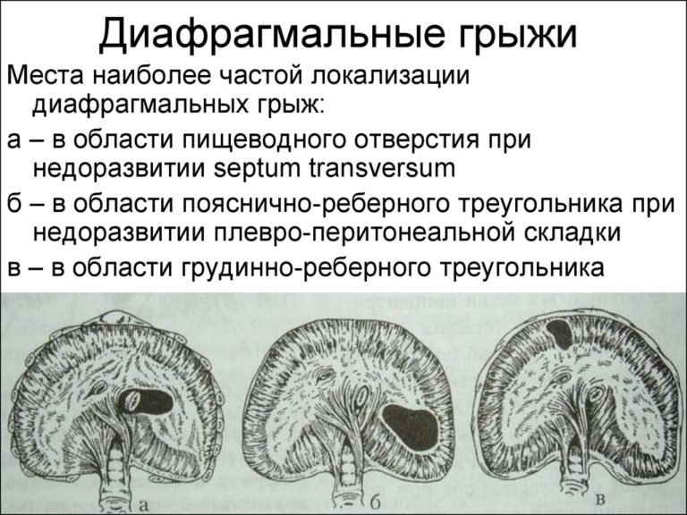 Презентация диафрагмальная грыжа