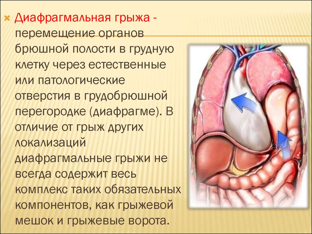 Диафрагмальная грыжа клиническая картина