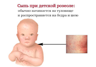 Сыпь только на животе у ребенка без температуры