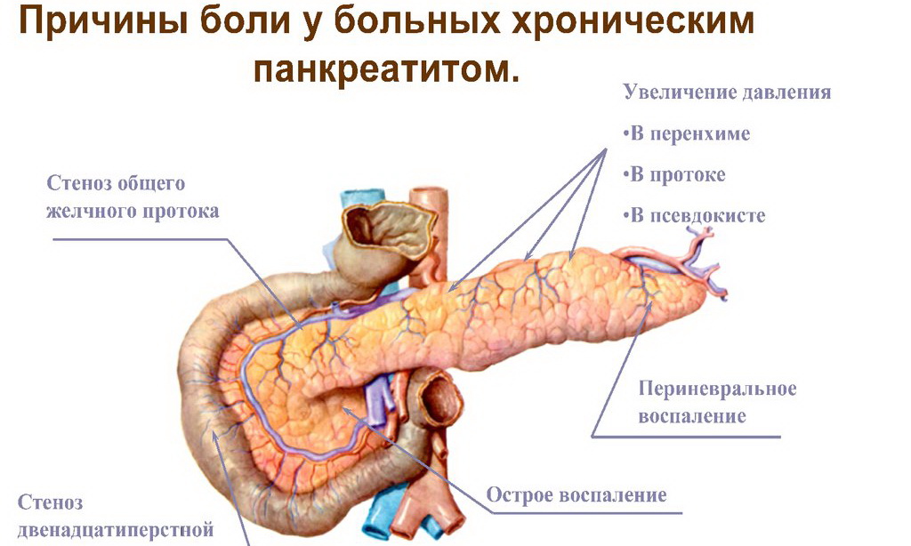 Поджелудочная железа приступы боли. Хронический панкреатит поджелудочная железа. Болезнь хронический панкреатит поджелудочной железы. Симптомы панкреатита поджелудочной железы. Панкреатин поджелудочная железа.