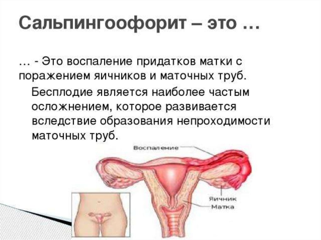 Воспаление матки у женщин симптомы и лечение. Воспаление маточных труб. Воспаление придатков матки. Придатки матки воспаление.