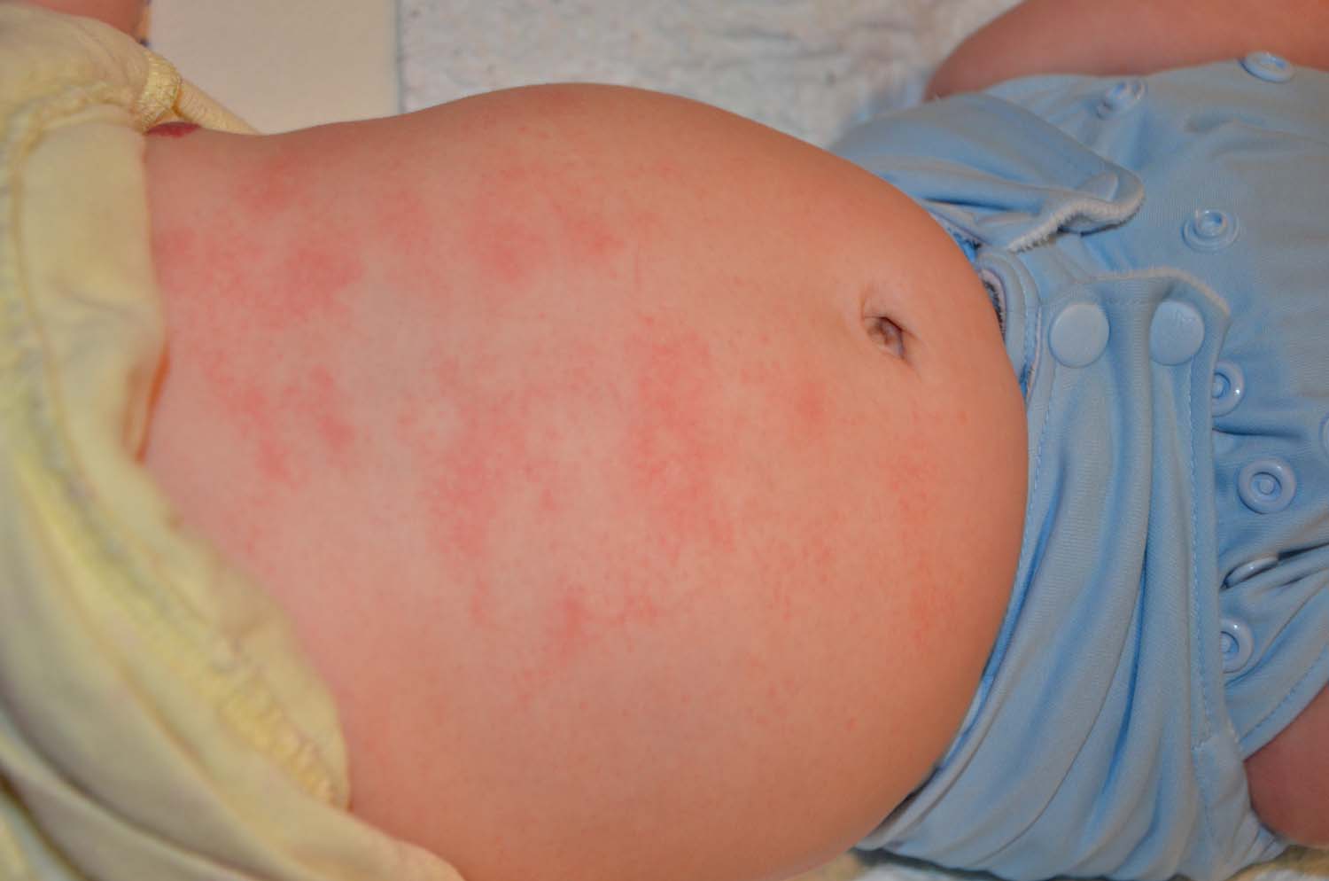 Red Spots On My Baby Body