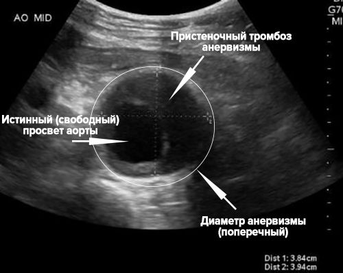 Аневризма аорты узи. УЗИ заключение брюшного отдела аорты с аневризмой. Расслаивающая аневризма брюшной аорты УЗИ. Заключение УЗИ аневризмы брюшной аорты. УЗИ брюшного отдела аорты атеросклероз протокол.