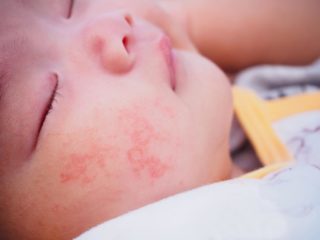 Аллергия проявляясь в виде высыпаний и боли в животе говорит о непереносимости ряда продуктов