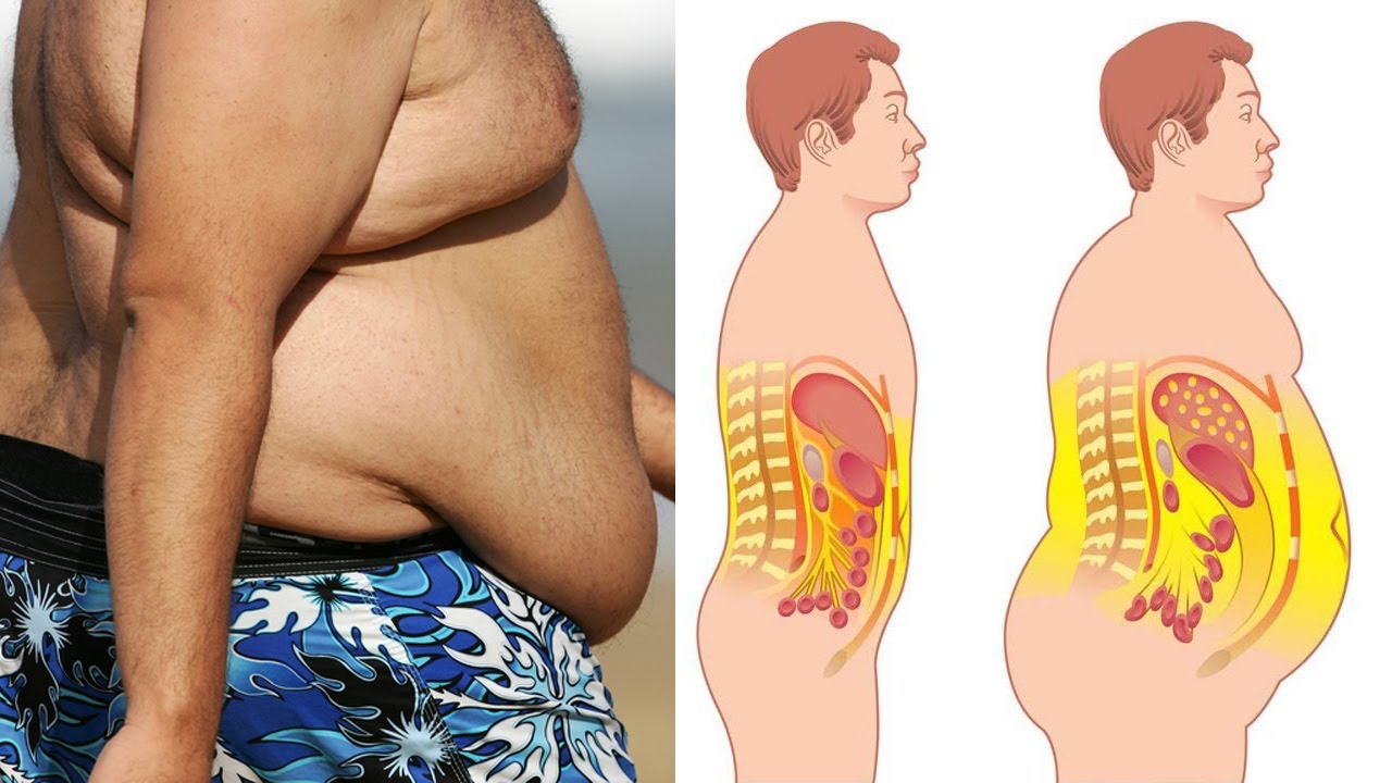 Живот у мужчин причины после 50. Висцеральный жир анатомия. Висцеральное ожирение.