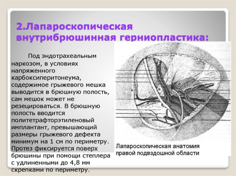 Грыжа белой линии живота карта вызова смп